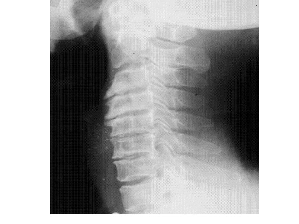 Arthritis Symptoms Symptoms Of Cervical Arthritis