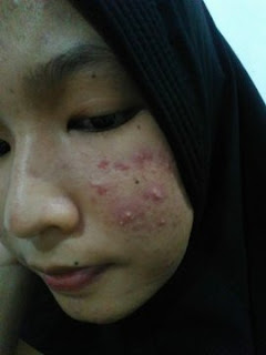 Perjuangan Melawan Jerawat Dengan Skincare di Bawah 100k