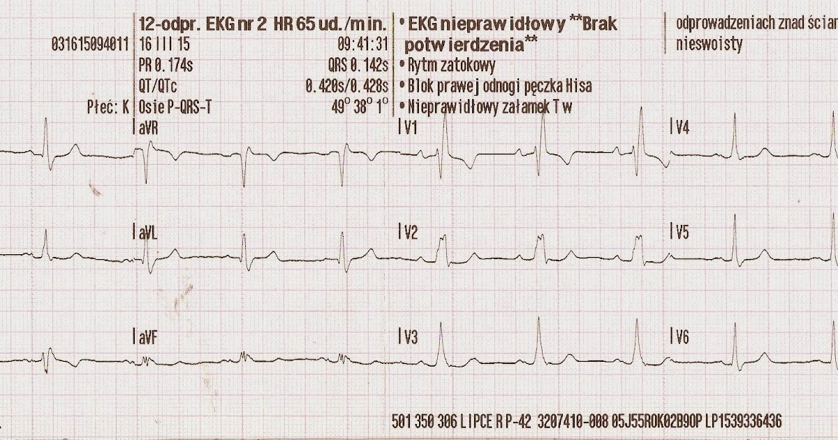 Blok Prawej Odnogi Peczka Hisa Ekg Kardiologia ratunkowa i nie tylko... : RBBB czyli blok prawej odnogi pęczka Hisa