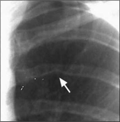 Posterior rib notching