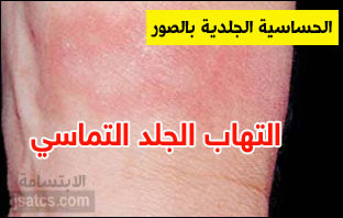 حساسية الجلد وانواعها بالصور والوصف الدقيق