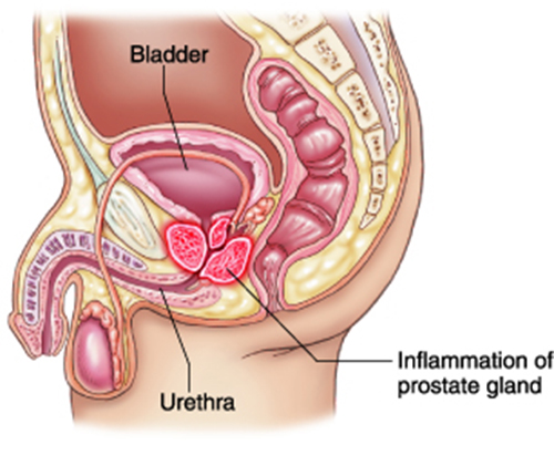 prostatitis pain running