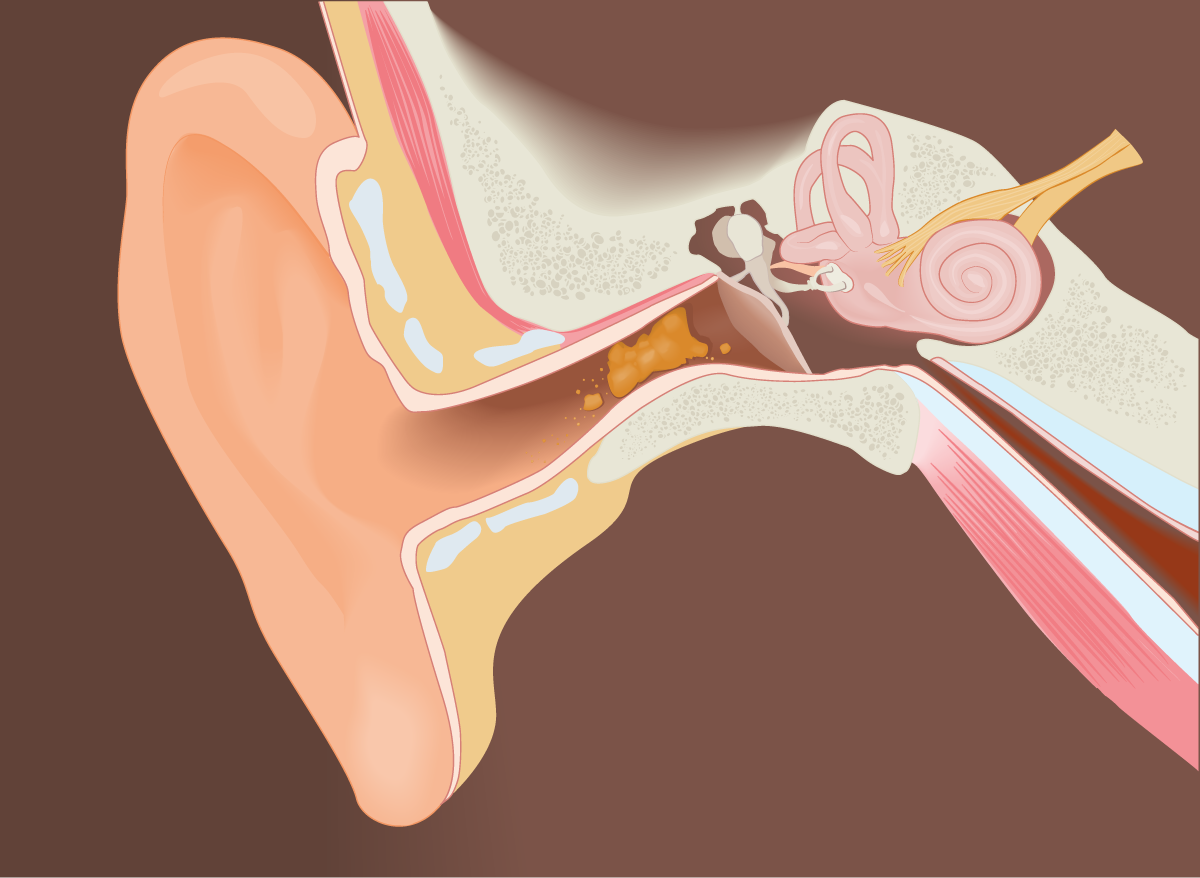 Наружный отит серная пробка. Анатомия уха серная пробка. Как прочистить ухо от серной
