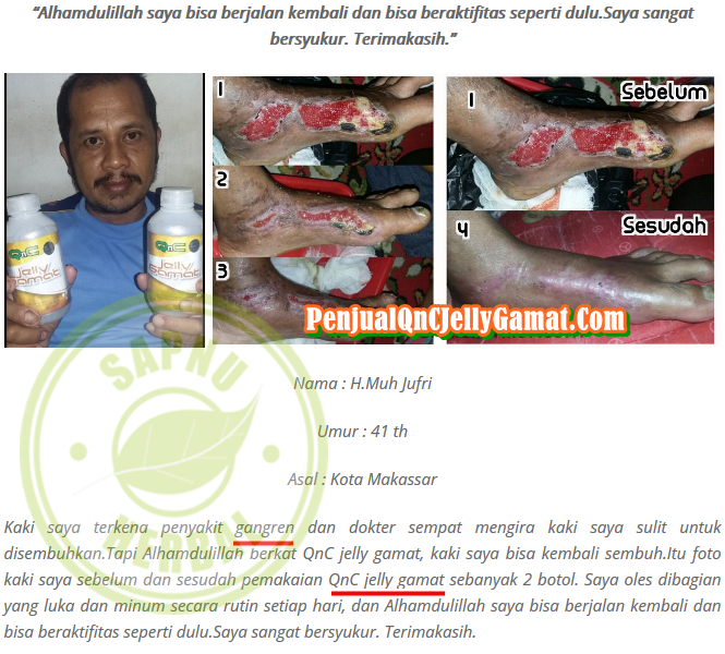 Cara Menyembuhkan Luka Borok Bernanah Dan Berair Secara Alami ~ Testimoni QnC Jelly Gamat Cara Menyembuhkan Luka Borok Bernanah Dan Berair Secara Alami ~ Testimoni QnC Jelly Gamat