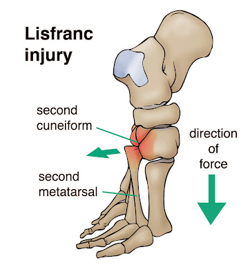 Lisfranc Injury Mechanism of Injury - El Paso Chiropractor