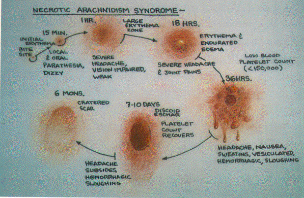 Health Fitness Hobo Spider Bite Symptoms health-fitness-hobo-spider-bite-symptoms