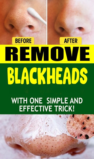 Remove Blackheads With One Simple And Effective Trick Wellness Days 