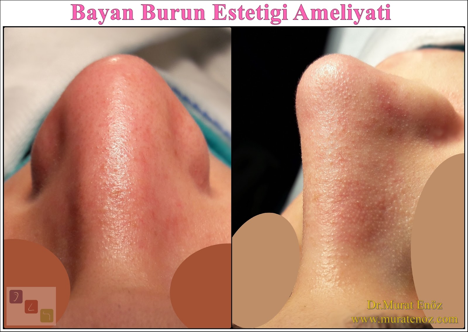 Bayan Burun Estetiği Ameliyatı