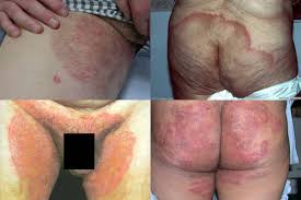 Nama Obat Khusus Gatal Jamur Kulit Pada Bokong dan Pangkal Paha Ampuh Nama Obat Khusus Gatal Jamur Kulit Pada Bokong dan Pangkal Paha Ampuh