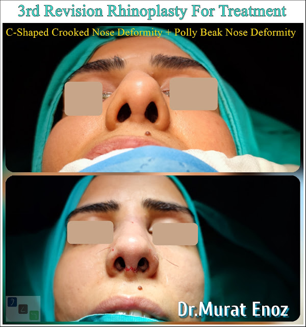 3rd Revision Rhinoplasty For Treatment of "C-Shaped Crooked Nose Deformity" + "Polly Beak Nose Deformity"