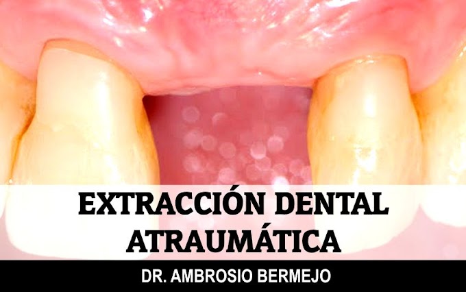 EXODONCIA: Extracción Dental Atraumática - Dr. Ambrosio Bermejo 