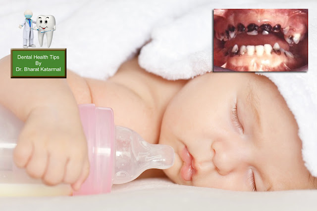 Bottle feeding danger for baby milk teeth advised by jamnagar dental surgeon