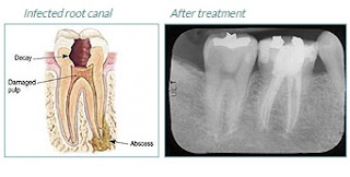 root canal treatment in Hertfordshire