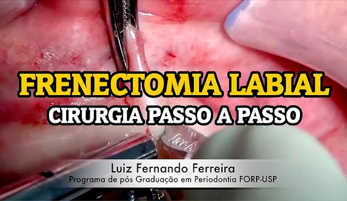 FRENECTOMIA LABIAL: Cirurgia passo a passo - Luiz Fernando Ferreira