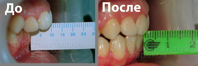 Сагиттальная щель до и после лечения Два фото измерения сагиттальной щели до и после лечения