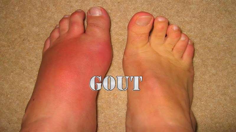 Inspirasi Spesial Penyakit Gout, Gambar Sandal