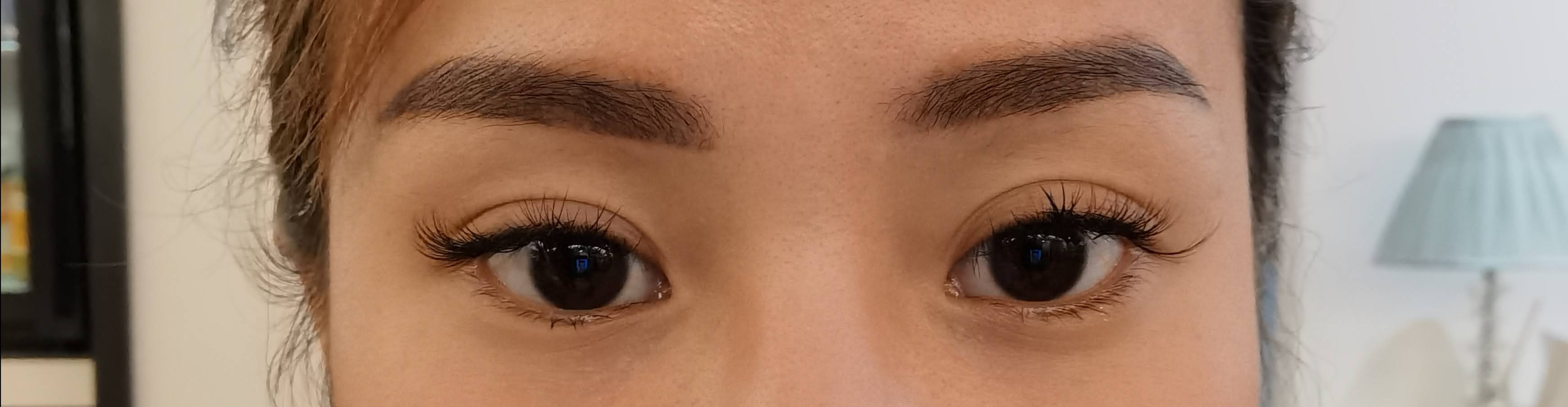 My Epicanthoplasty Journey with The Clifford Surgery Clinic aggylow