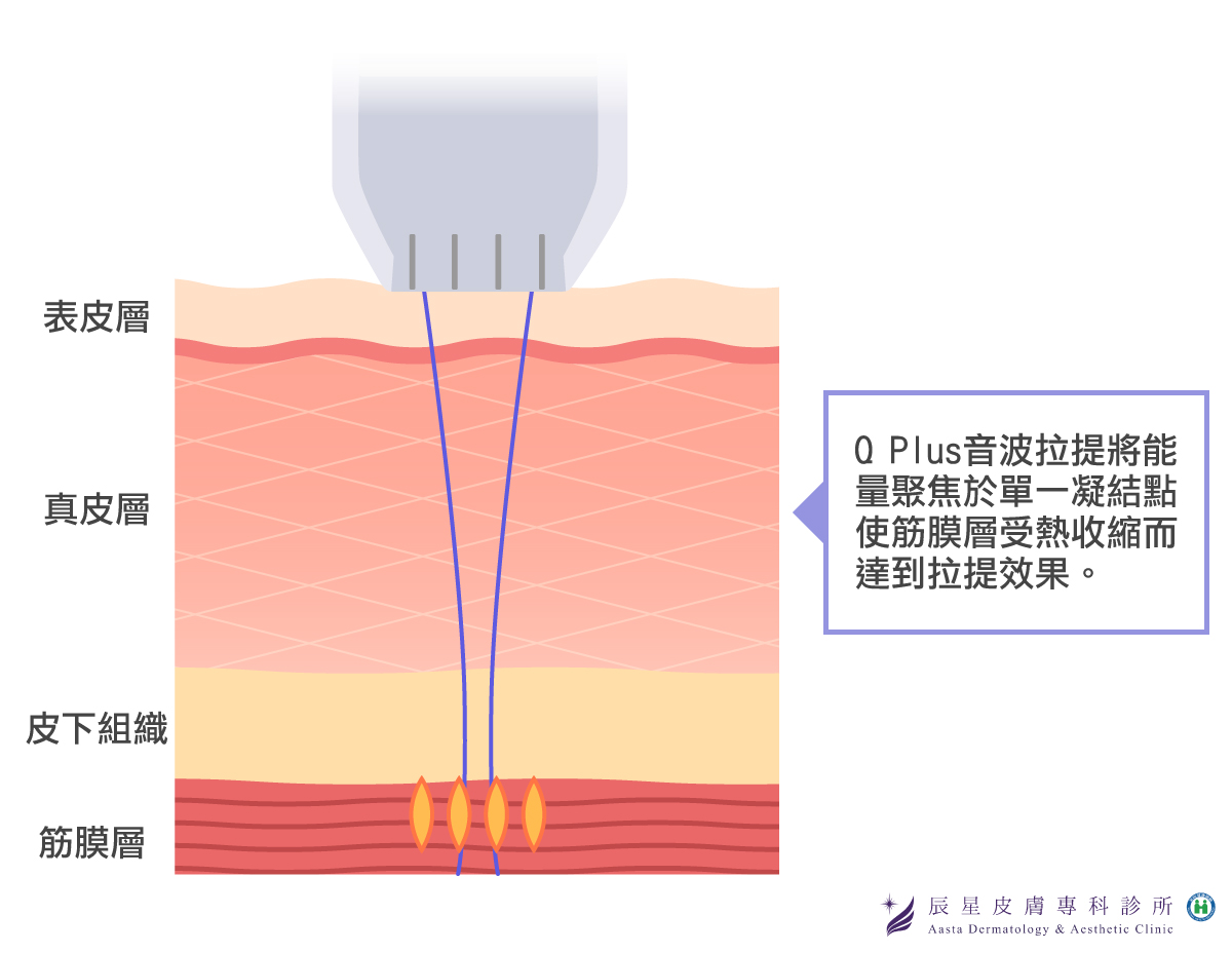Q+音波拉提 Q+音波拉提