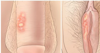 Obat bibir miss v gatal perih mengelupas karena sipilis
