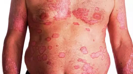 Psoriasis