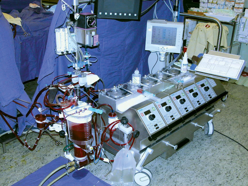 Global Artificial Heart Lung Machines Market 2020 Size Share