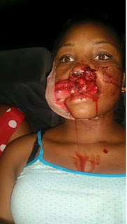 Girl Shot in the Mouth by Gunmen