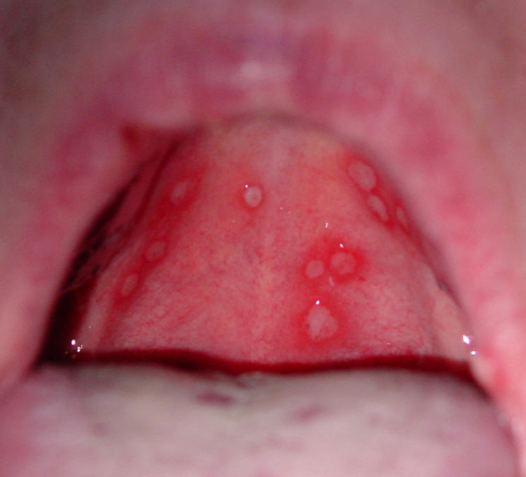 Red Bumps In My Throat 71