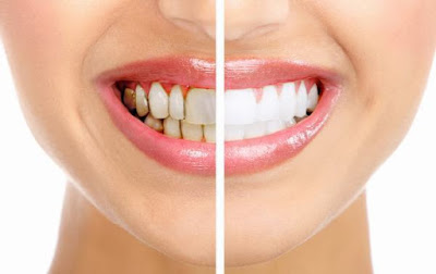Răng sứ có bị đổi màu không? Cách nào kéo dài thẩm mỹ cho răng-2?