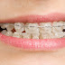 Răng móm vì sao phải điều trị?