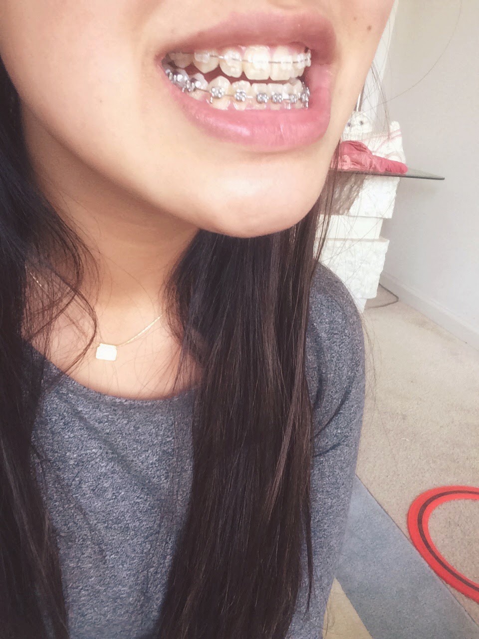 Amanda's Underbite Story Braces!