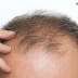 What are the causes of hair loss? What are the natural ways to prevent hair loss? What are the causes of hair loss? What are the natural ways to prevent hair loss?