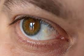Home Remedies For Pterygium