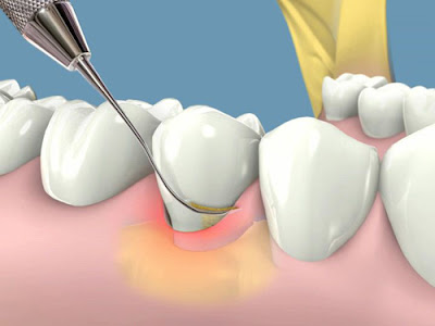 Cách chữa viêm lợi chân răng hiệu quả tại nhà-2