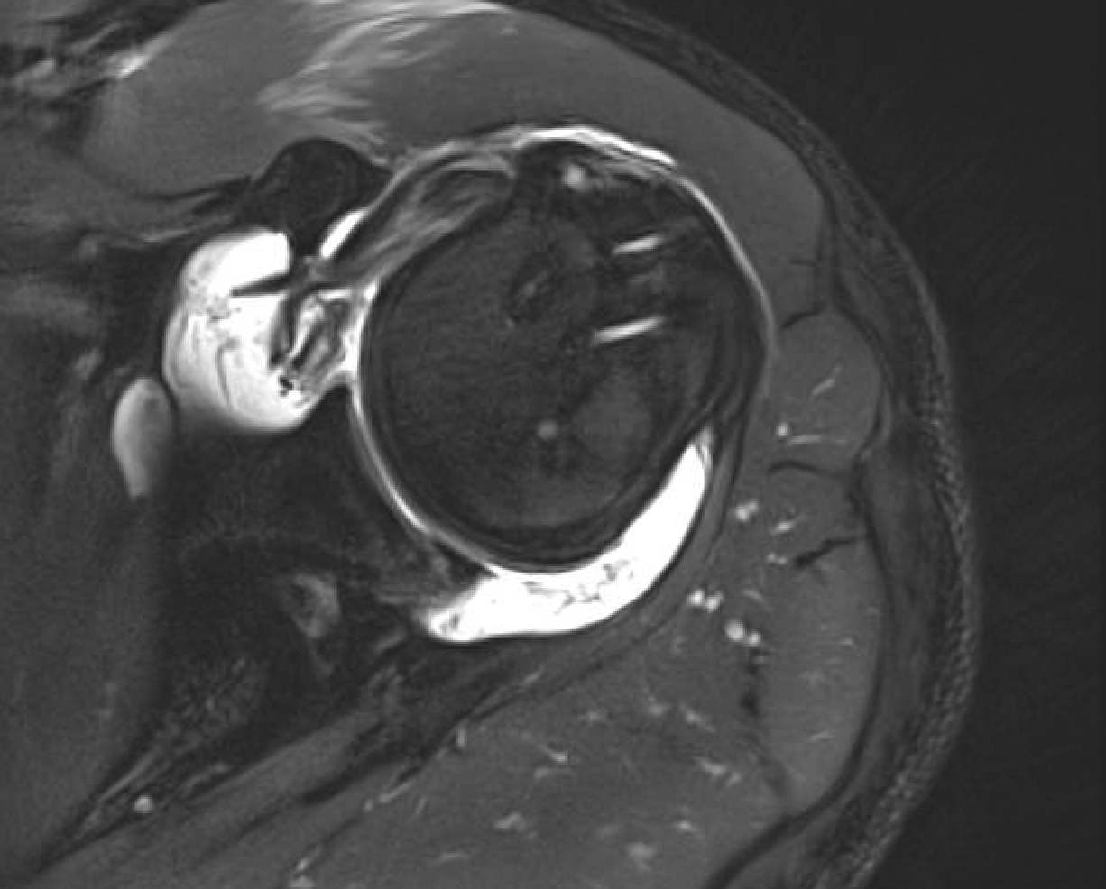 Shoulder Arthritis/Joint Replacement Rotator cuff tears Irreparable