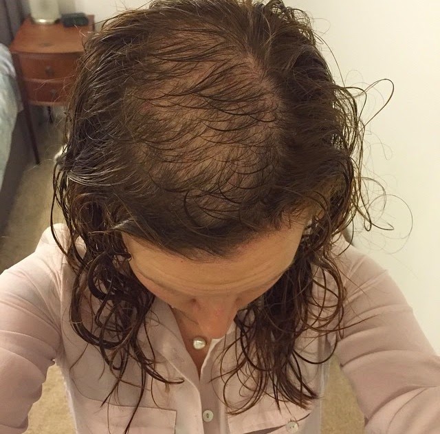 Hair Loss And Trichotillomania How To Cover Up Bald Patches Pretty