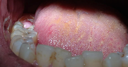 My Dental Diary: pulp polyp