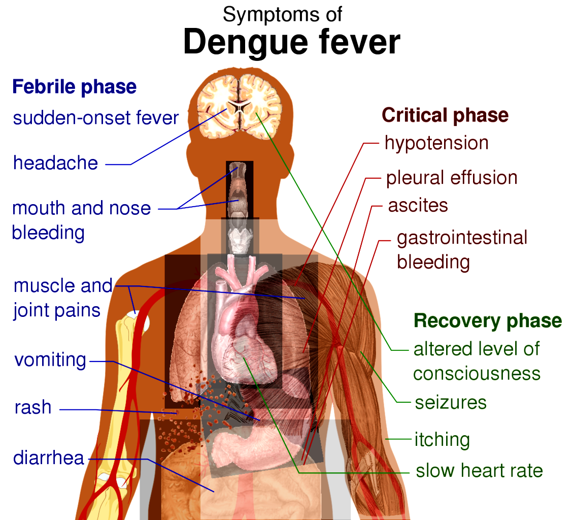 Symptoms of Dengue Fever