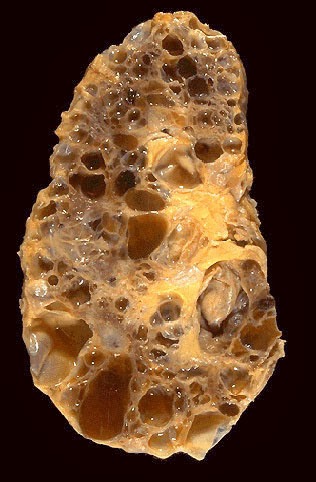 Liga de Patologia - UFC: Doenças Císticas do Rim