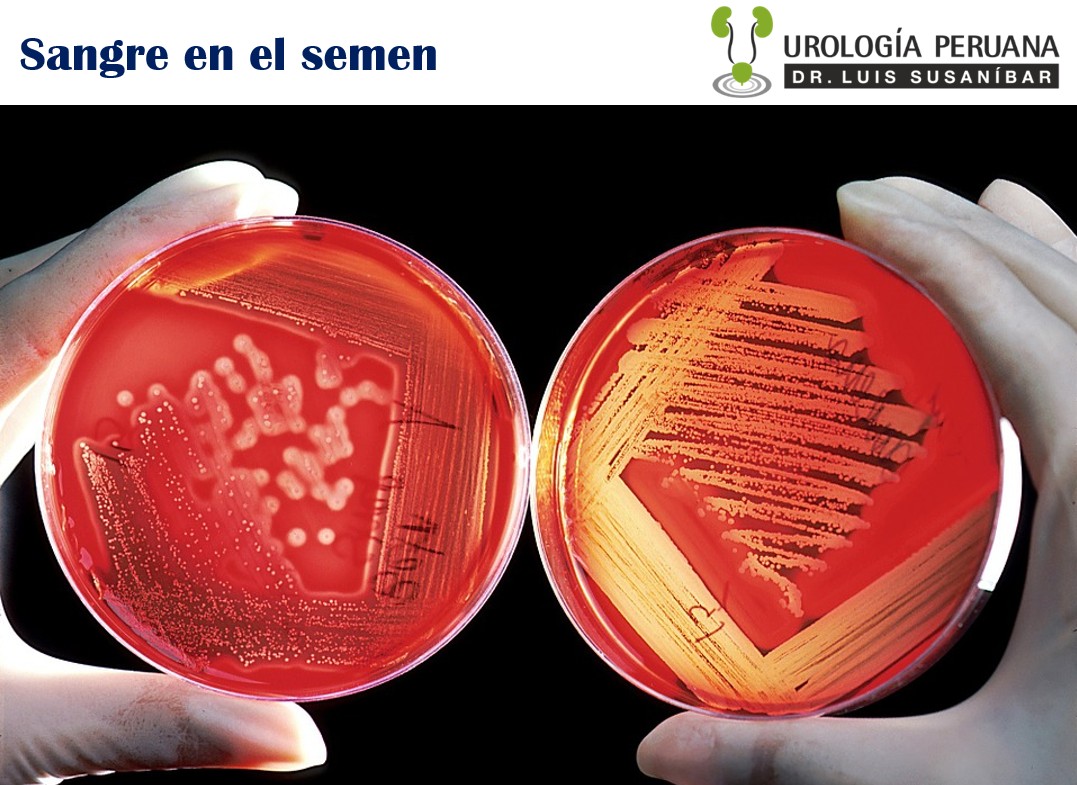 Que es hematospermia