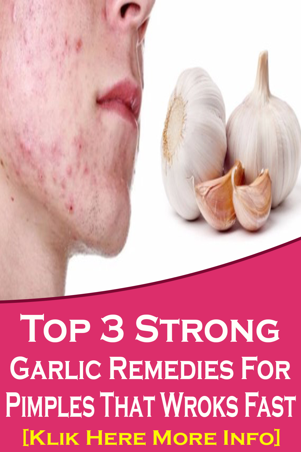 How To Get Rid Of Pimples With Garlic exstremboard