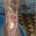 Diabetic Foot Ulcer : causes, Prevention and Management of Diabetic Foot Ulcer