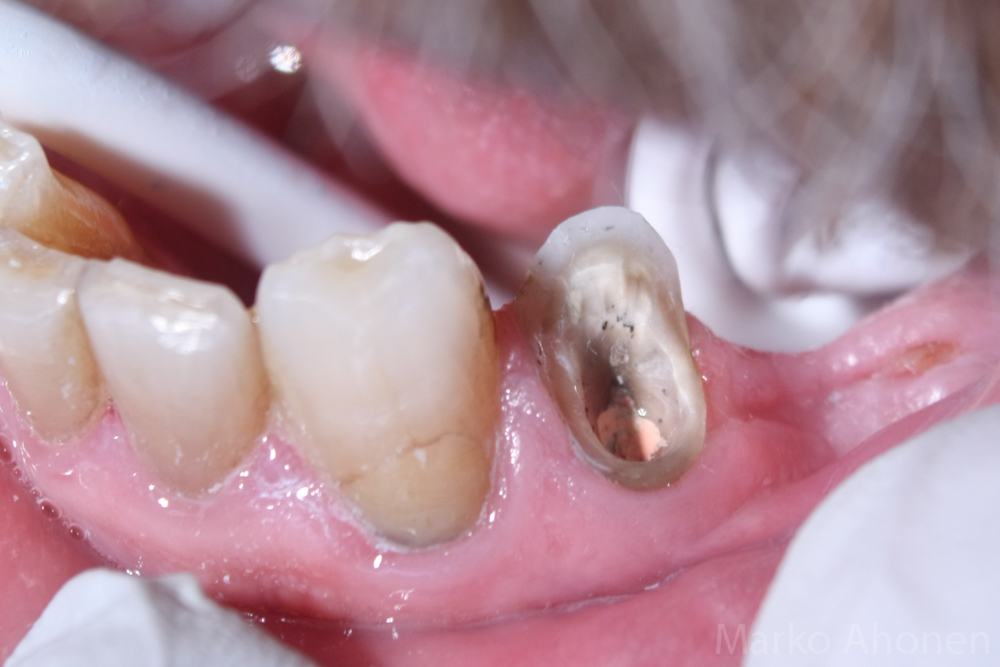Cerec Finland Juurihoidetun Hampaan 34 Endokruunu cerec-finland-juurihoidetun-hampaan-34-endokruunu