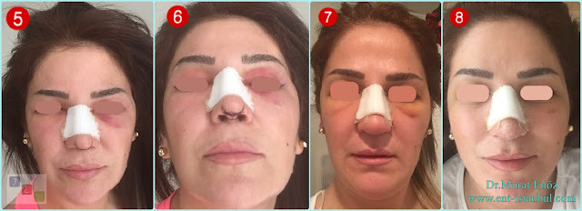 bruising on the 5th, 6th, 7th and 8th days after the rhinoplasty operation