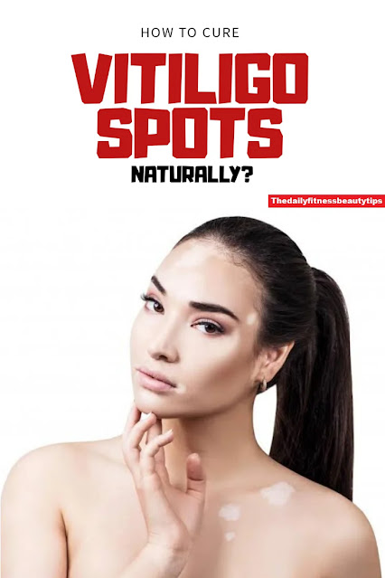 Natural Treatment for Vitiligo