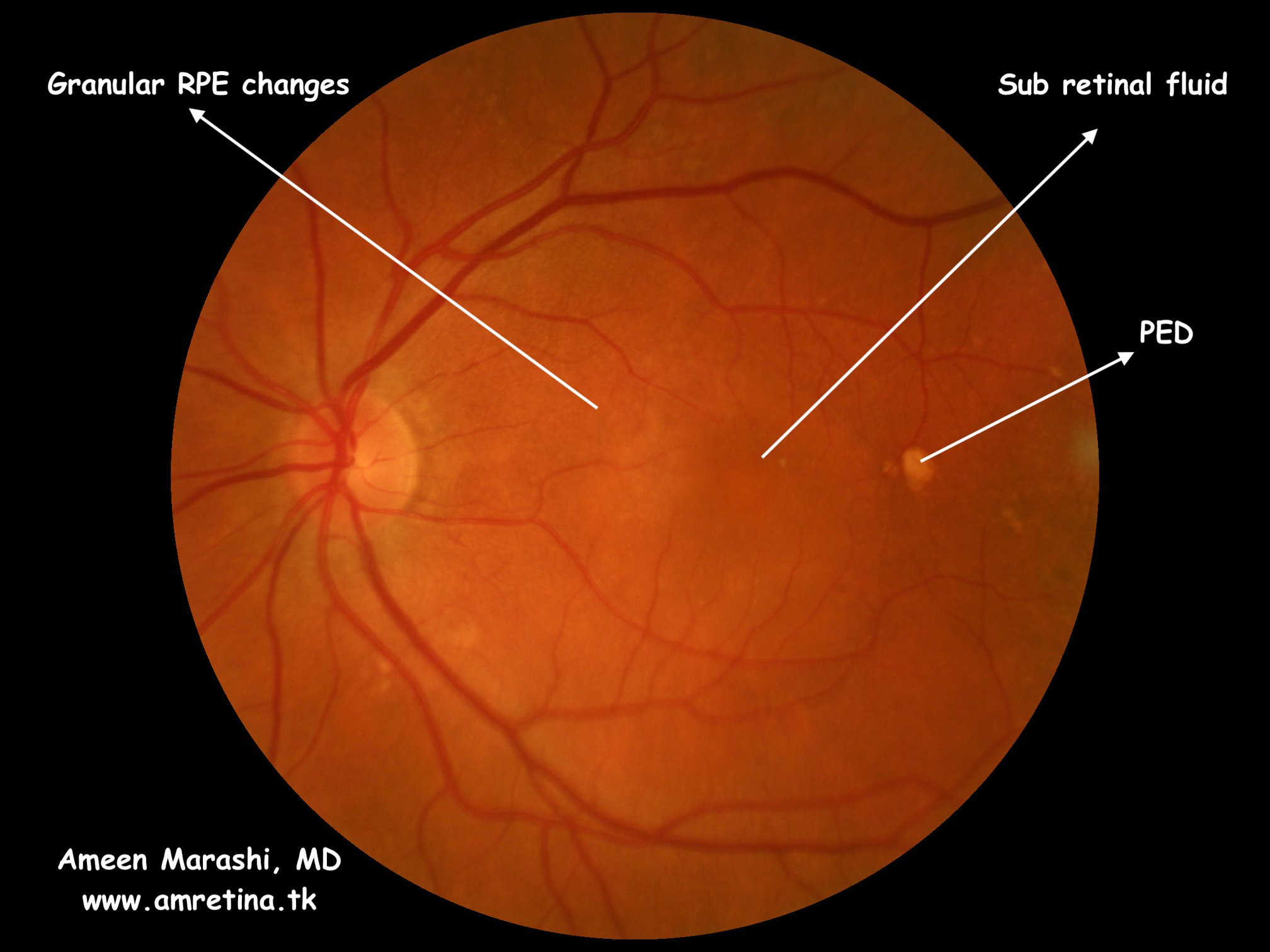 Chronic Central Serous Chorioretinopathy fundus image, OCT and FFA in a