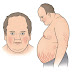 Σύνδρομο Cushing, με αύξηση βάρους, εύκολη κόπωση, υπέρταση, διαβήτη, αγχώδεις διαταραχές 