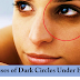 What are the causes of Dark Circle Under Eyes?