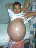 xơ gan cổ chướng