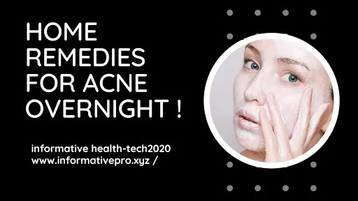 home remedies for acne cure overnight