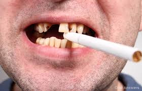 Hút thuốc lá gây hại răng miệng và nhiều vấn đề sức khỏe nghiêm trọng khác